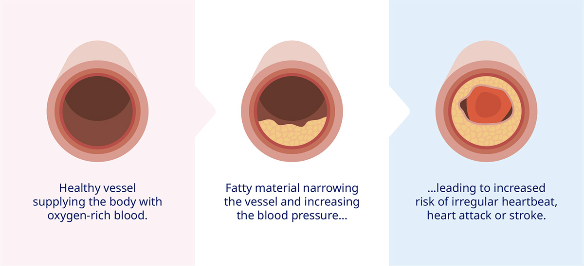 Cvd Examples What is atherosclerotic cardiovascular disease? | ASCVD